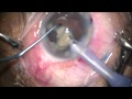 Phacoemulsification of white cataract 1 