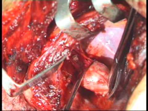 Sintomi miosite di trattamento della colonna vertebrale cervicale Ñ ‡ Ñ, о нужно ÐÐμÐ »Ð ° N, NOE Ð¿Ñ € Ð Ð ± ол n n n ... D² пинÐμ D