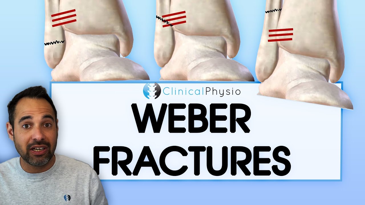 What is a er B fibula fracture? Tipseri