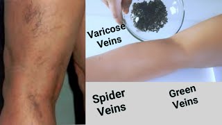 EASIEST WAY TO GET RID OF VARICOSE VEINS | GREEN VEINS AND SPIDER VEINS