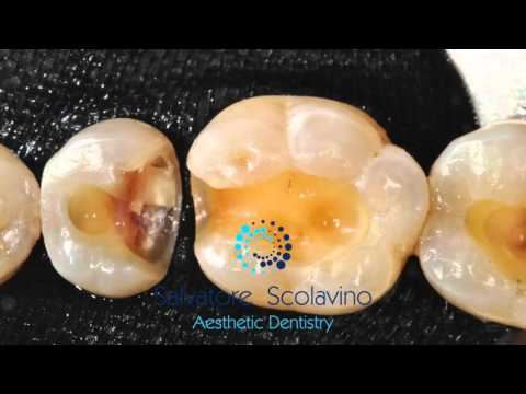 Cavity preparation in posteriors. Salvatore Scolavino
