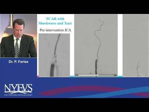 Discussion TCAR is all I need for carotid stenting Peter Faries Debate  Endovascular therapy vs Surg