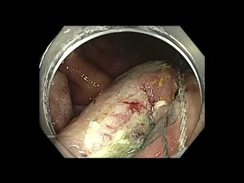 Coloscopie: Tumeur de la valvule iléo-colique - résection endoscopique