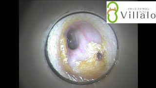 耳掃除動画vol.39「かさぶたも取れました」