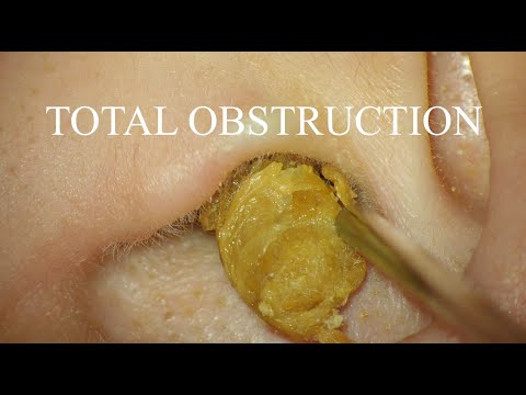 TOTAL OBSTRUCTION : EAR WAX REMOVAL : 4K/HD