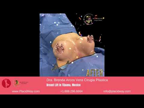 Redefining Radiance: A Patient's Journey of Breast Lift with Dra. Brenda Arcos in Tijuana, Mexico