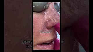 Rosacea and Nose Capillaries #shorts #shortvideo