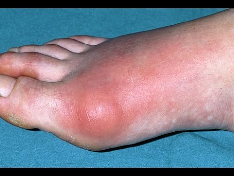 A lábízületek polyarthritis kezelése