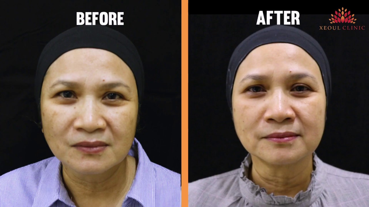 Mela Peel Forte Treatment with Xeoul Clinic Subang Jaya | Melasma Pigmentation Spots &  Brightening