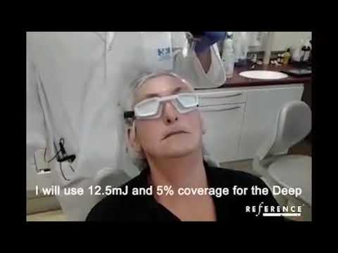 Dr. Matteo Tretti Treating Wrinkles with AcuPulse | Lumenis