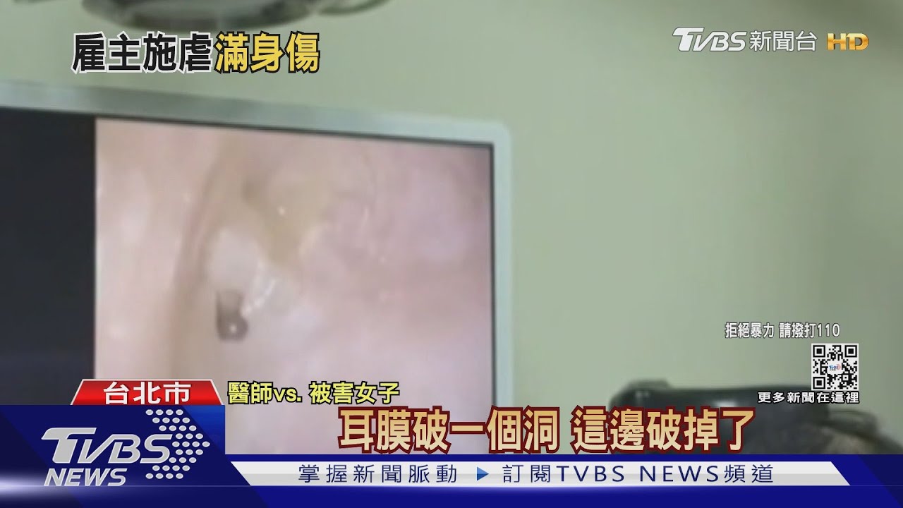 滿身傷! 控遭雇主施暴14個月 女移工提告