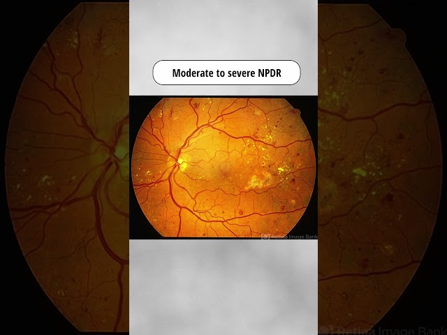 How Diabetes Damages the Retina | Diabetic Retinopathy (PDR, DME, NPDR, TRD)