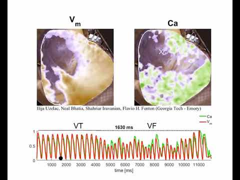 Researchers map rotating spiral waves in live human hearts