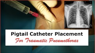 Pigtail Catheter Placement for Traumatic Pneumothorax