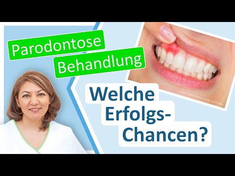 Parodontose-Behandlung: Wie sind die Erfolgschancen bei einer Parodontitis? Zahnarzt Großostheim