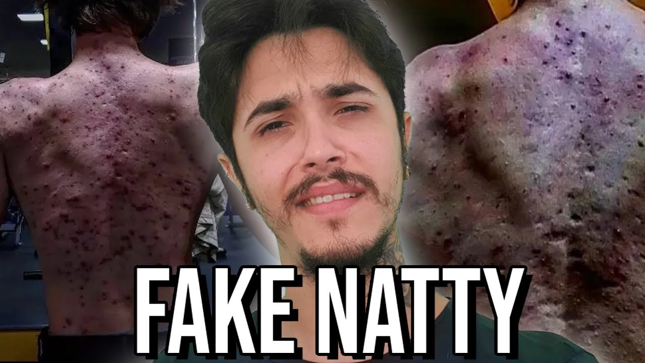 Os Efeitos colaterais de anabolizantes são estranhos (só coisa paia)