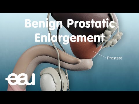 Benign Prostatic Enlargement (BPE)