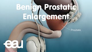 Benign Prostatic Enlargement (BPE)