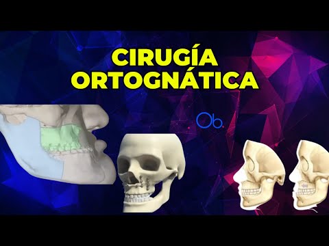 ¿Qué es la Cirugía Ortognática?