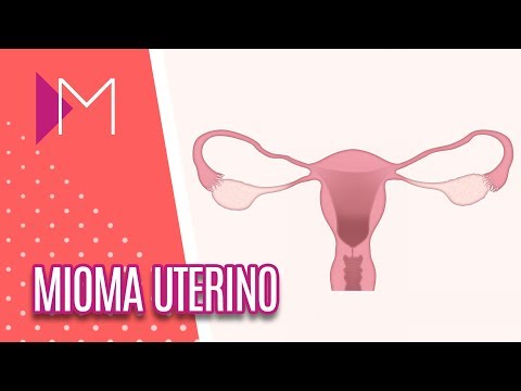 Mioma Uterino - Mulheres (14/12/2018)