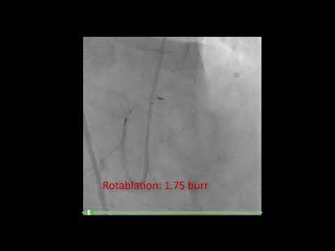 Left main PCI, Calcified aorto-ostial lesion