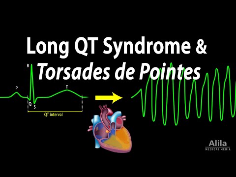Long QT Syndrome and Torsades de Pointes, Animation