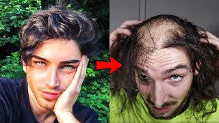 24 Year Old Model Had A Transplant But Stopped Taking Hair Loss Meds And This Is What Happened