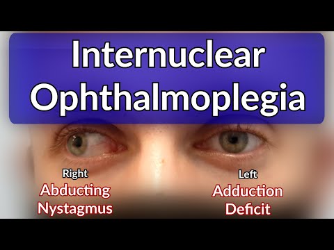 Internuclear Ophthalmoplegia - Left INO Case example explained