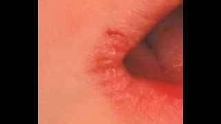 Cracked Lip Corners Treatment | Angular Cheilitis