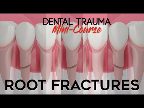 Dental Trauma Mini-Course - Part 6 - Dental Trauma Guide - Root Fractures