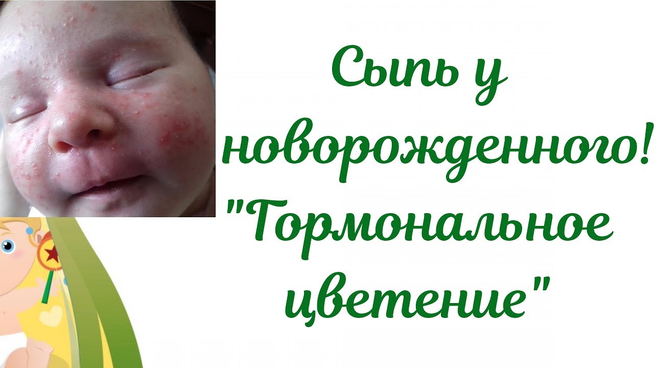 Акне новорожденных! Сыпь у новорожденного ребенка👶Гормональное цветение