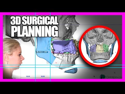 Planowanie 3D operacji ortognatycznej