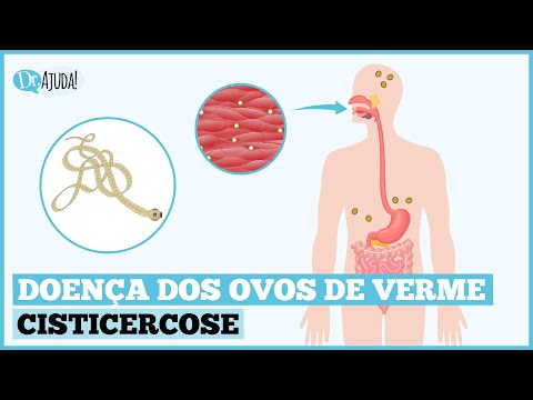 CISTICERCOSE: O QUE É, SINTOMAS, DIAGNÓSTICO, TRATAMENTO E PREVENÇÃO