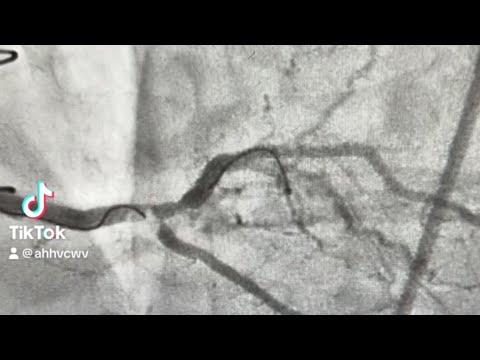Tips & Tricks to wire a complex side branch ostial lesion!