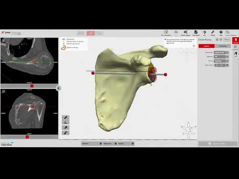 B-0085-V3-001-2_072400_VPR_LIMA-SHOULDER-PRE-OP-PLANNER_EN