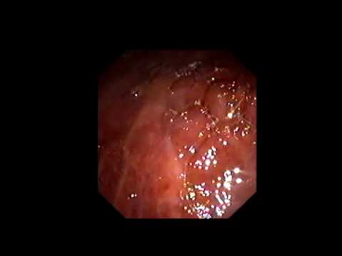 comment soigner gastrite