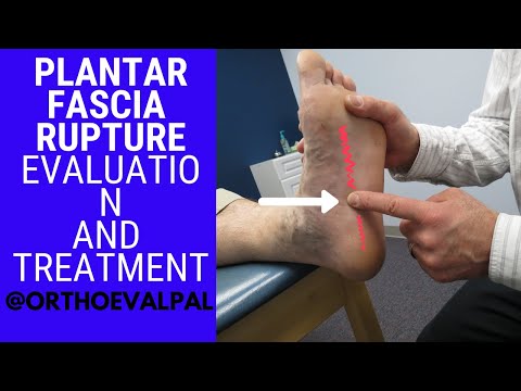 Plantar Fascia Rupture Evaluation with Paul Marquis PT