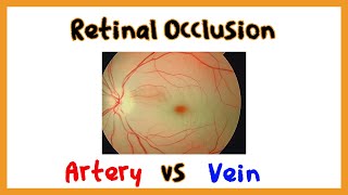 Retinal Artery Occlusion vs. Retinal Vein Occlusion