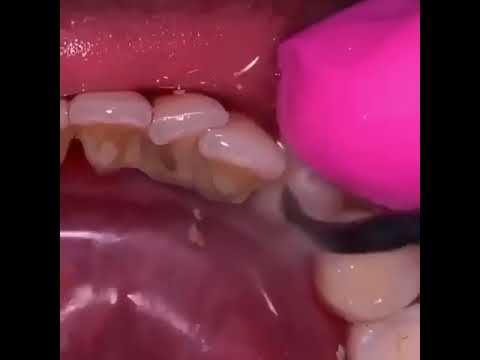 تنظيف الأسنان thumbnail