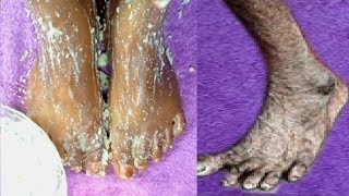 HOW I REMOVE WRINKLES ON MY FEET IN 2 DAYS |GET RID OF DRY ROUGH LOOKING FEET