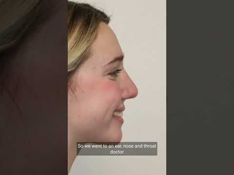 Rhinoplasty Patient Testimonial