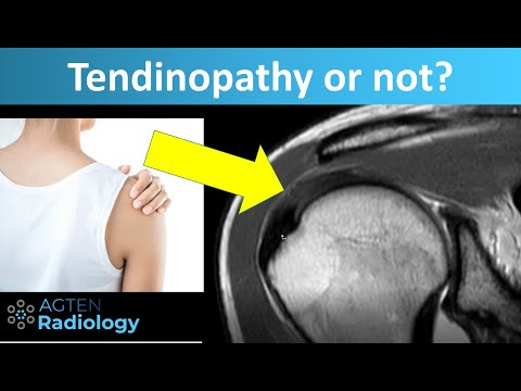 Tendinopathy (Tendinosis) of Rotator Cuff Tendons on MRI