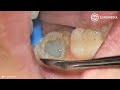 Failed Root Canal Treatment on a Wisdom Tooth: Extraction