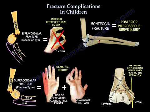 Common Pediatric Fracture Complications