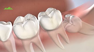 preview picture of video 'Post Operative Instructions: Wisdom Teeth Extractions - Utah Surgical Arts | Provo UT'