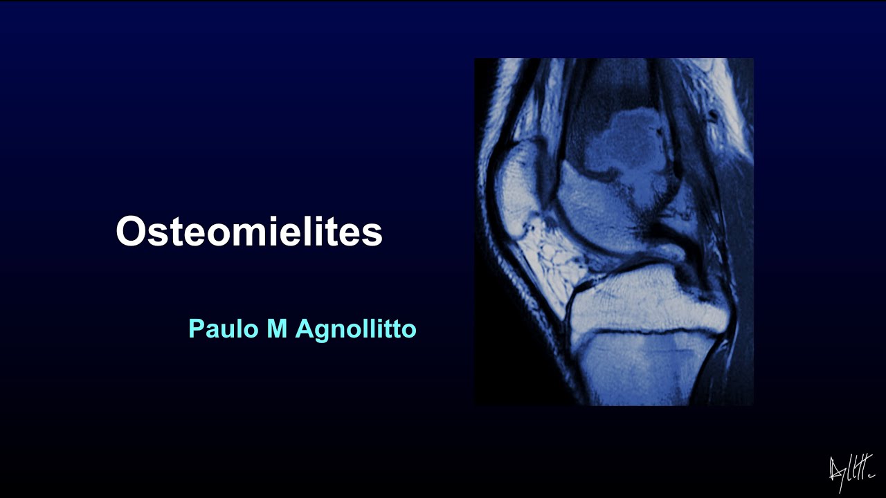 OSTEOMIELITES: AVALIAÇÃO POR IMAGEM
