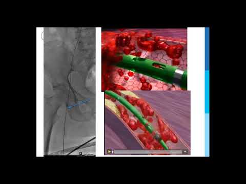SIR-RFS Webinar (8/13/2018): Venous Thromboembolic Emergencies in the Oncologic Patient