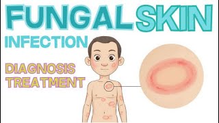 FUNGAL SKIN INFECTIONS - DIAGNOSE AND TREAT FAST!
