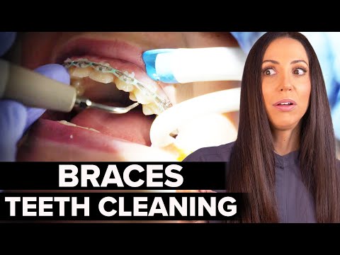 Braces Teeth Cleaning at the Dentist