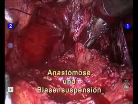 Konifere Nadel für Prostata-Extrakt Behandlung von Prostatitis Kerzen Antibiotikum